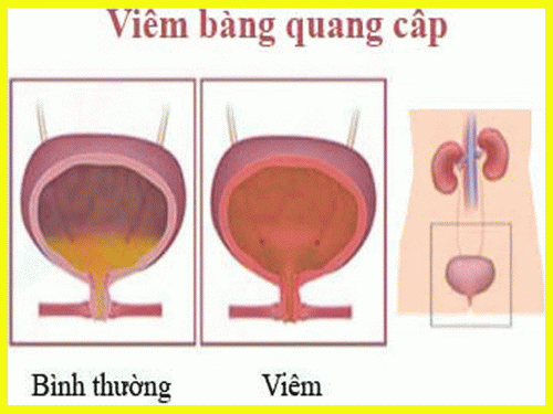 viem-bang-quang-cap