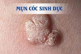 mun-coc-sinh-duc