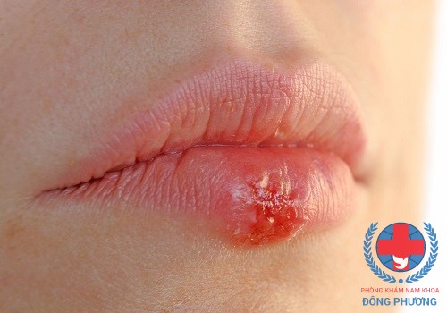 Herpes môi – căn bệnh mọi người nên lưu ý!