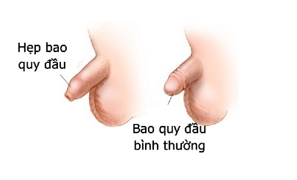 Bi Hep Bao Quy Dau