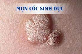 Mun Coc Sinh Duc