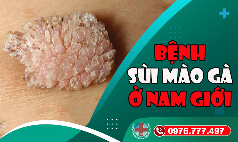 Bệnh sùi mào gà ở nam giới xuất hiện chỉ vì 3 lỗi ngớ ngẩn này
