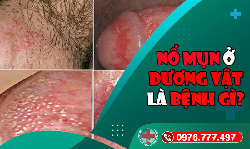 Nổi mụn ở dương vật là bệnh gì – Có nguy hiểm không?